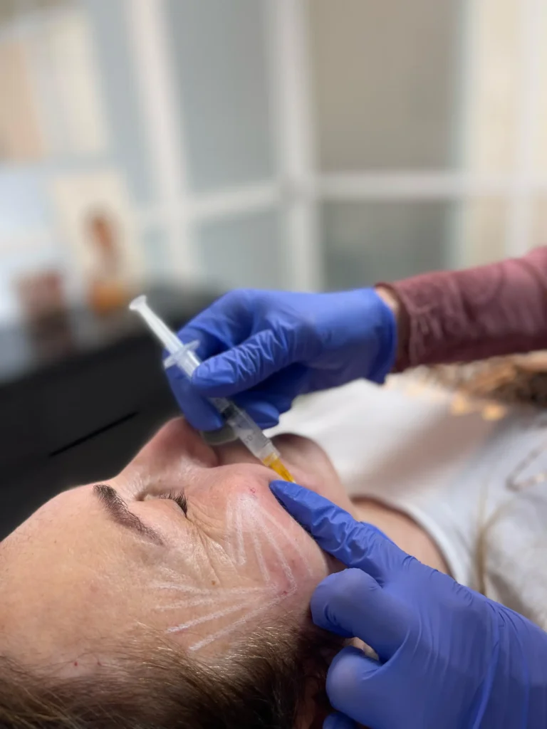 Sculptra tratamiento