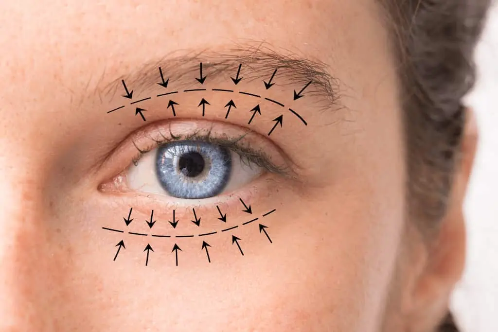 blefaroplastia
